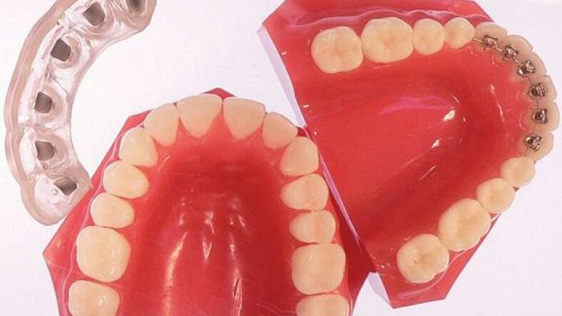 Simpli5 : la prochaine génération du traitement orthodontique invisible