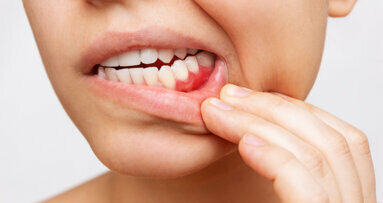 Parodontalno zdravljenje je neučinkovito pri težkih kadilcih s hudim parodontitisom, ugotavlja študija