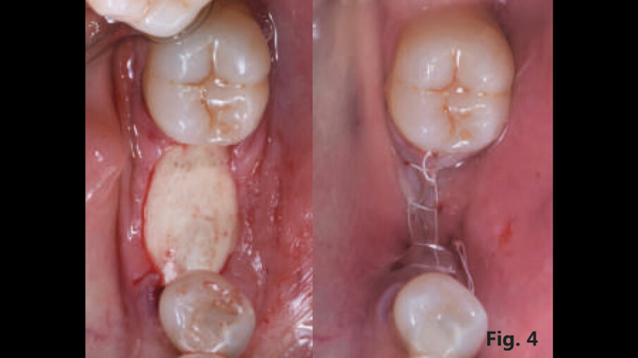 Fig. 4 - Riempimento del difetto e sutura del lembo a permettere una guarigione per prima intenzione.
