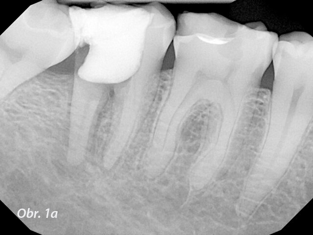 Řešení endodontických selhání