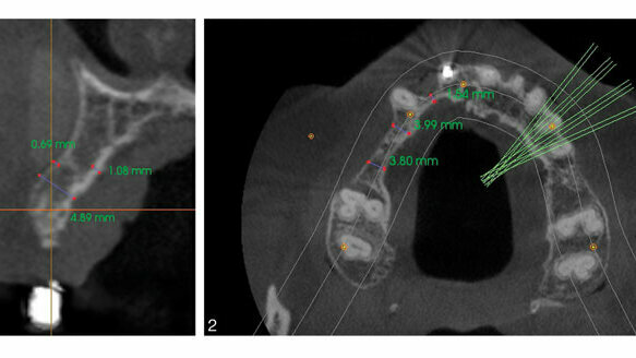 Comparing graft techniques for the alveolar ridge prior to implant