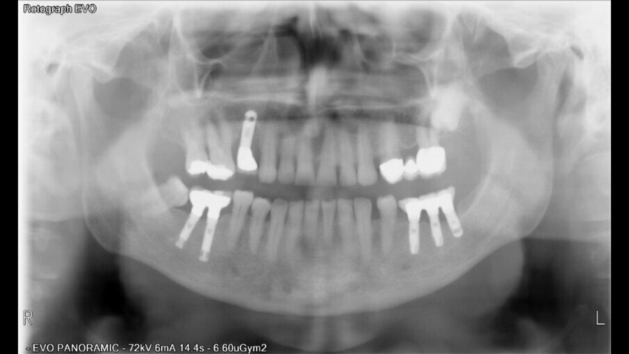 54letá pacientka trpěla rozsáhlým periodontálním defektem v oblasti zubu 44 se ztrátou kosti v apikální oblasti.