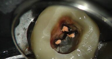De endodontische obturatie