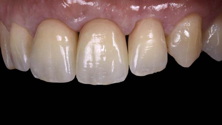 Figg. 15, 16_Risultato finale, si può notare l’ottima integrazione delle corone con i denti adiacenti.