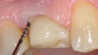 Peri-implantitis: from the diagnosis to the treatment