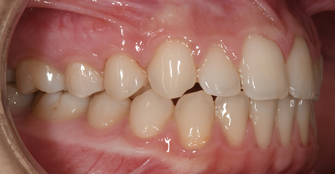 Fig. 22: Final intra-oral photograph. 