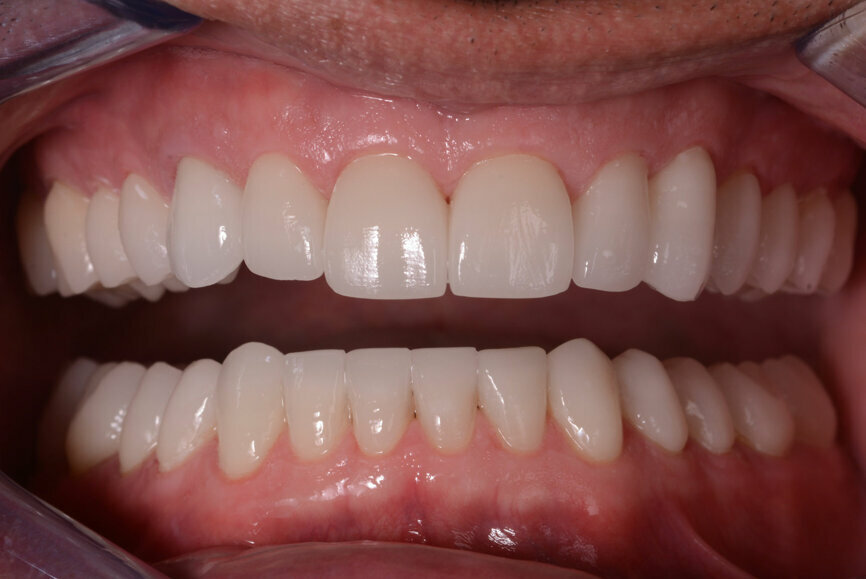 Figs 14: Intraoral photographs after treatment.
