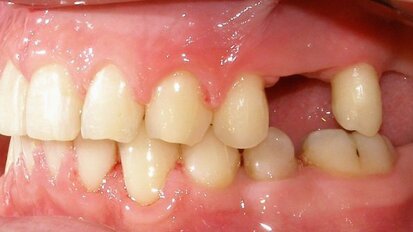 Le mouvement dentaire pourrait être une alternative aux greffes osseuses