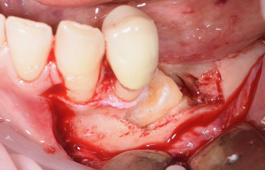 Fig. 8 - Odontotomia eseguita con inserto piezolettrico.