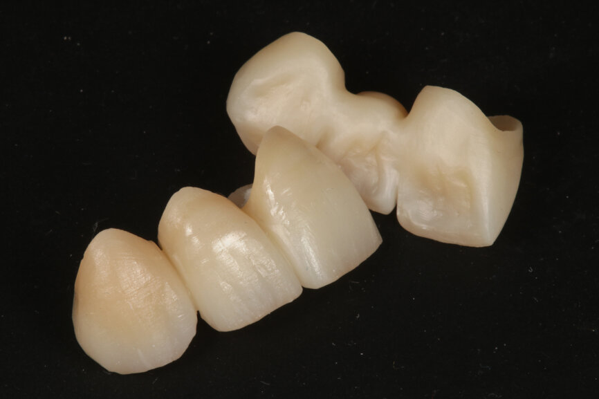 Fig. 11: Restorations after internal staining.