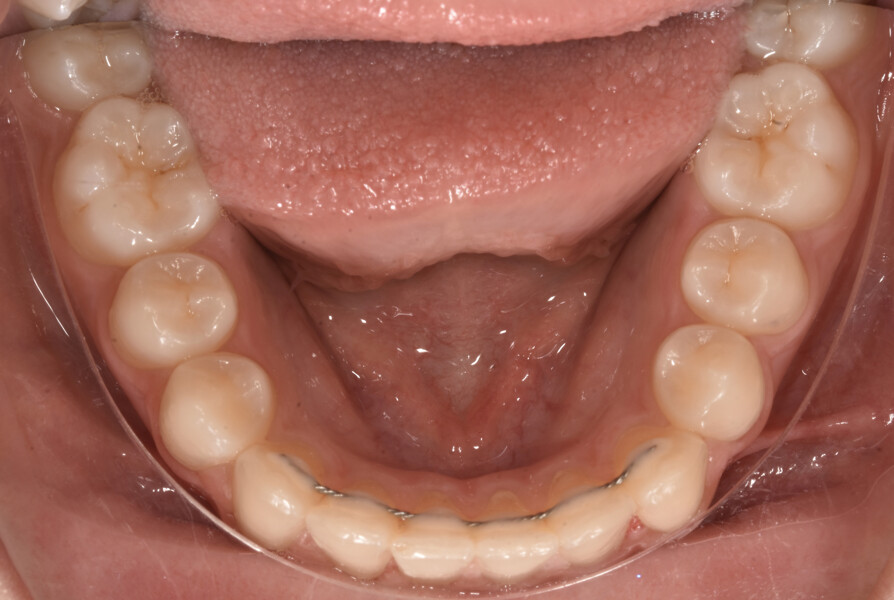 Fig. 9: Facial and intra-oral photographs after treatment with fixed orthodontic appliances.