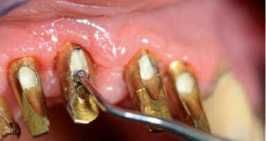 CFAO dentaire – Des piliers  sur mesure pour les patients et  une nouvelle conception d’implant