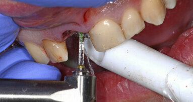 The use of new technologies and digital implant solutions in a one-stage surgical procedure