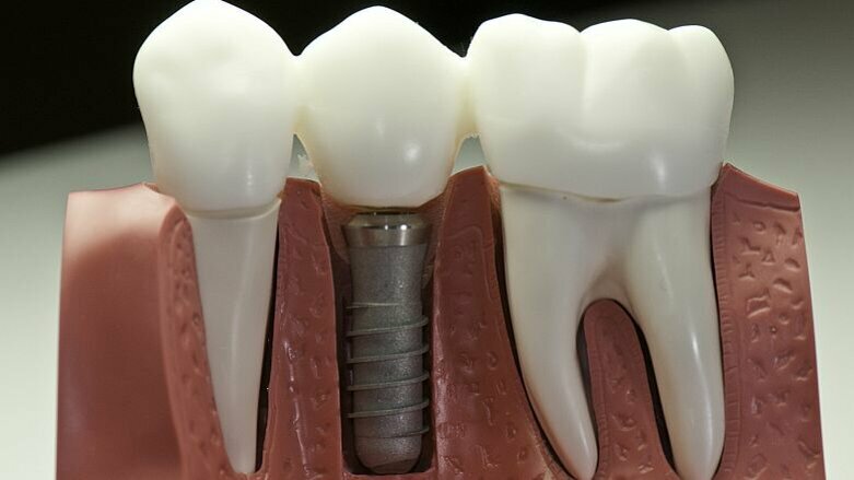 Dreptul de a insera implanturi dentare