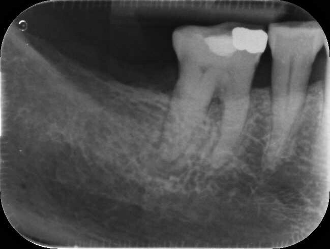 Fig. 14a: Case treated with Bassi Logic controlled memory nickel titanium files. Note the visualization of the third root on this lower molar and conservative canal preparation shape. (Courtesy of Dr. Alex Chan)