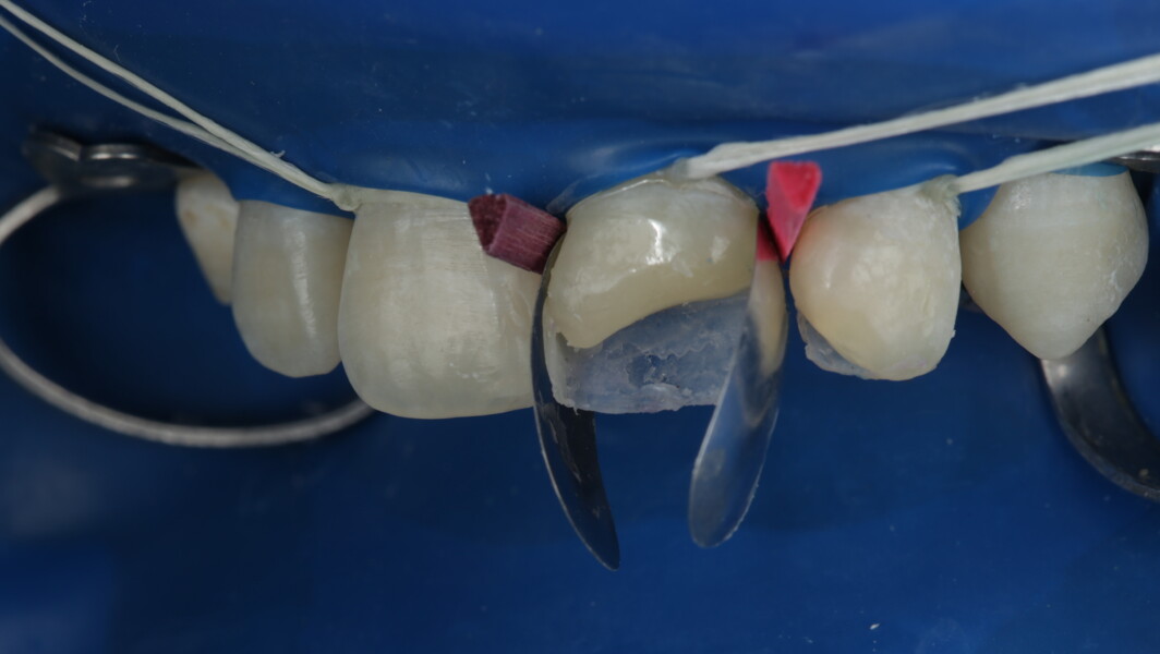 Fig 21: Mesial wall was built with A2 body shade.