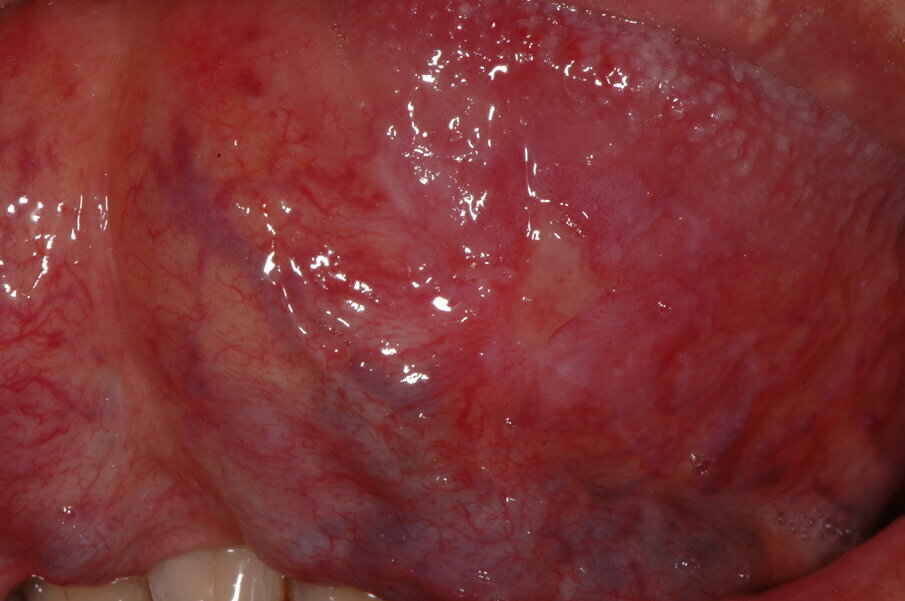 Fig. 2 - Paziente con ulcera del bordo linguale.
