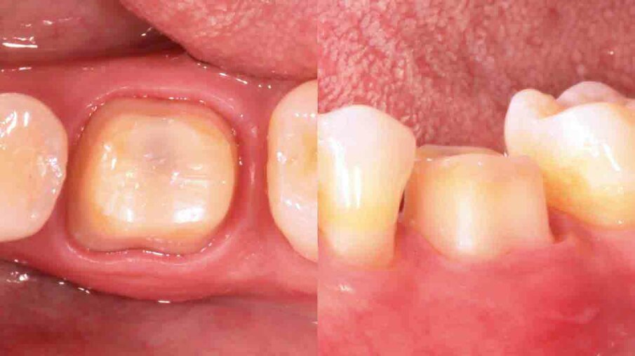 Fig. 8: Situation at intraoral try-in of the crown. It is made of a 3M™ Lava™ Zirconia coping and an IPS e.max® Ceram (Ivoclar Vivadent) porcelain layer. Ideal intraoral conditions (smooth margins, healthy tissues) are visible.