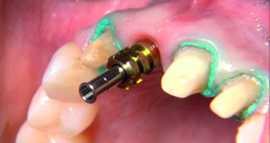 Immediate implantation and full-ceramic restoration in the maxillary anterior region
