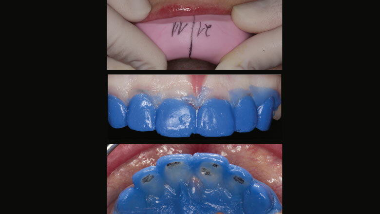 Figure 9: Examination of the prepared teeth using hydrocolloid