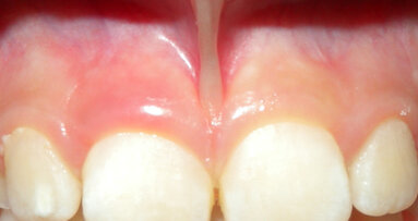 Frenulectomia Laser Nd:Yap gold standard della chirurgia orale pediatrica: a case report