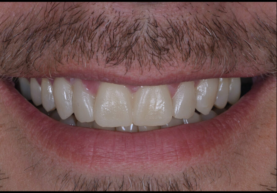 Fig 16: Mockup on 6 teeth