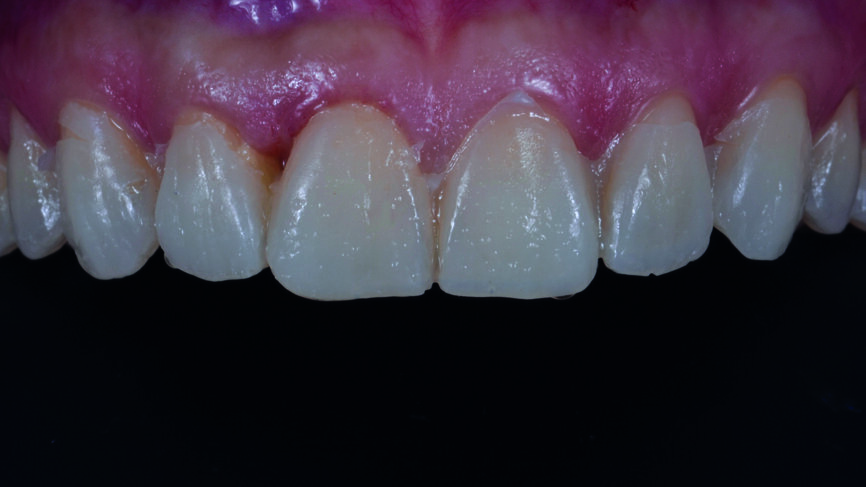 Fig. 8b : Dents antérieures après le traitement orthodontique.