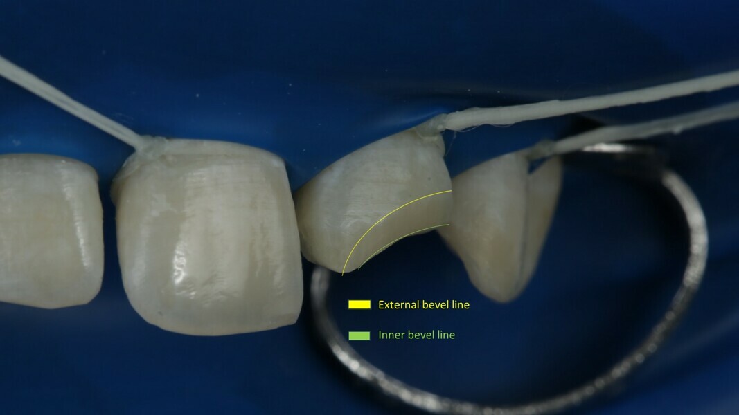 Fig 10: The bevel allows better integration between the composite restoration and the remaining dental tissue.