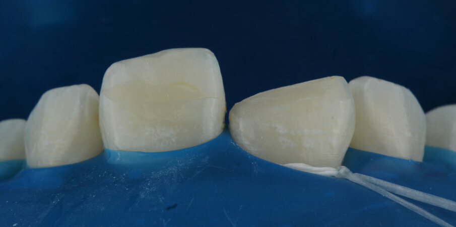 Case 1: After bevel placement and cleaning with Esthetrix Blaster