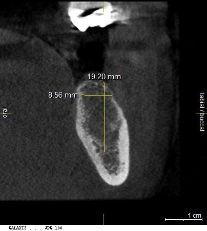 Fig. 2: CBCT scan measurements demonstrate availability of bone of adequate height and width.