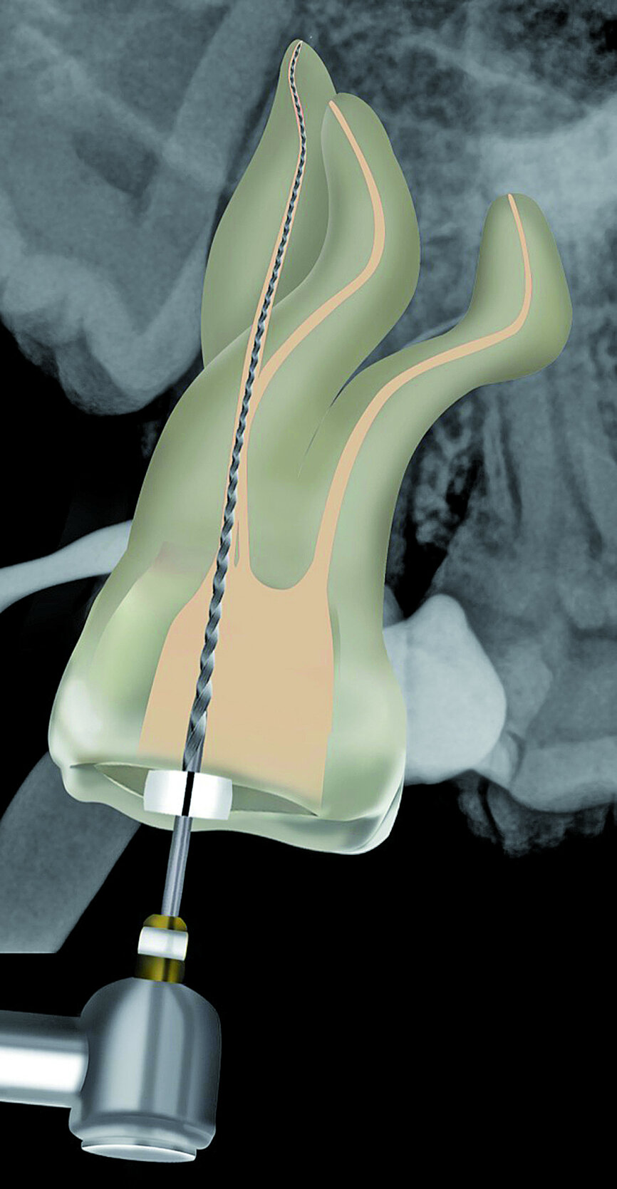 Fig. 23: A ProGlider was used in a rotary motion to expand the glide path in the palatal root canal.