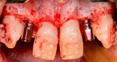 Zespołowe postępowanie terapeutyczne w przypadku wrodzonej hipodoncji siekaczy bocznych w szczęce