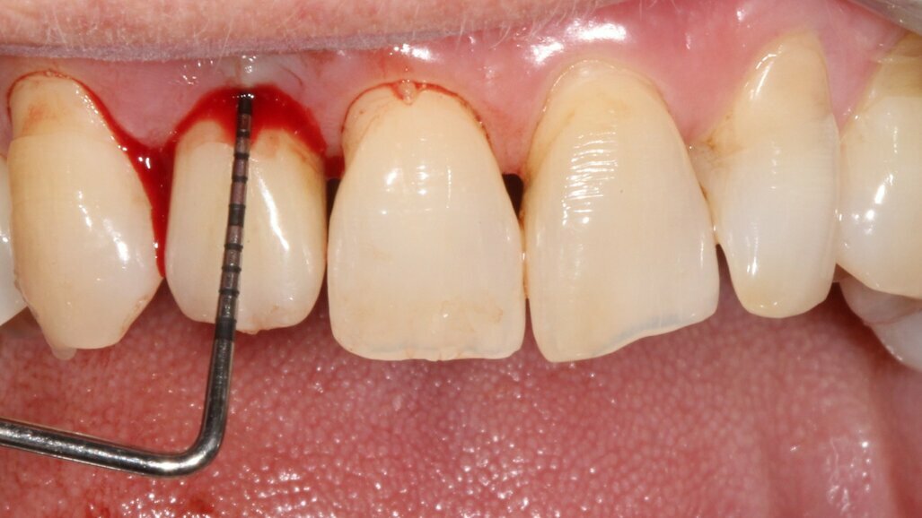 Valutazione dell’efficacia dello spazzolino elettrico Oral-B iO nei pazienti con riabilitazioni implantari fisse