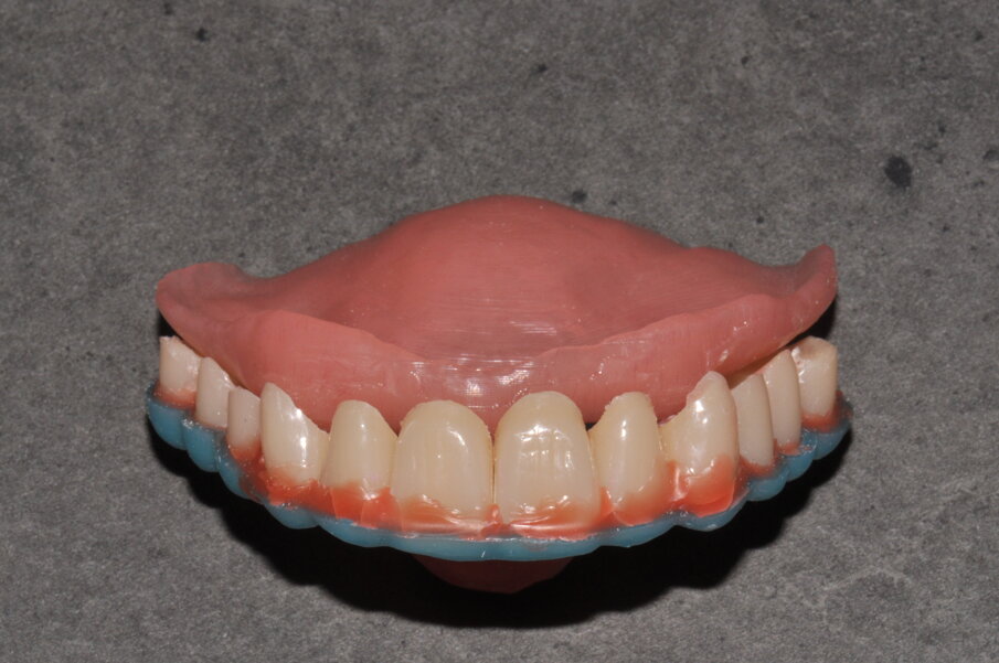 Fig. 19 - La placca base fresata, il template ottenuto con la stampa 3D ed i denti commerciali perfettamente inseriti.