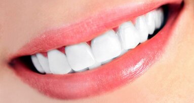 Tandbleekmiddelen mogelijk schadelijk voor tandbeenweefsel