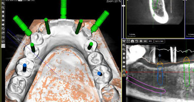 Počítačem asistované, šablonou se řídící okamžité zavedení a zatížení implantátu v dolní čelisti