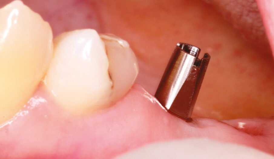 Fig.15: Stock abutment placement with margin 0,5 mm subgingival. 