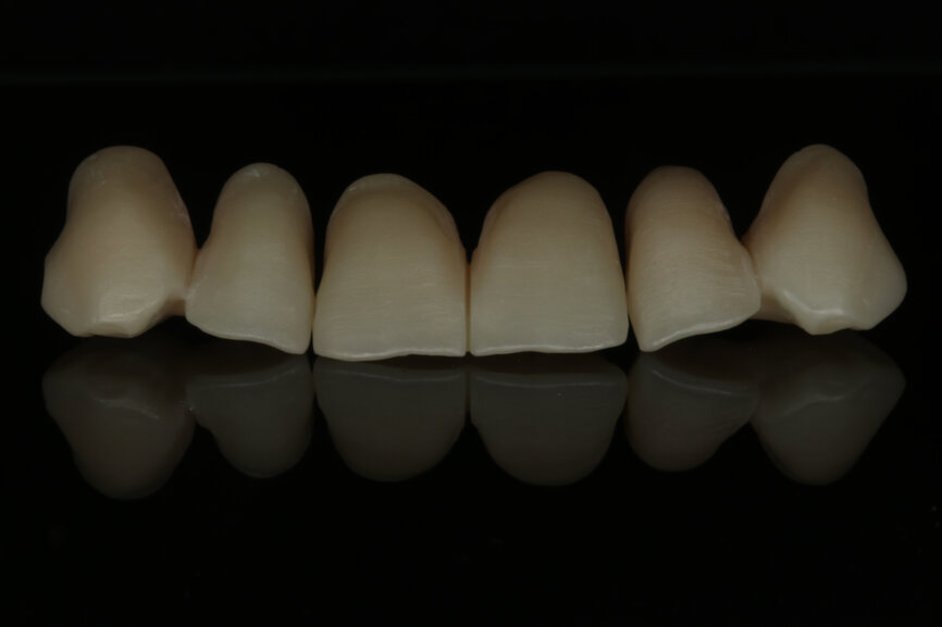 Fig. 3: Appearance of the individualized restorations after the final sintering procedure.
