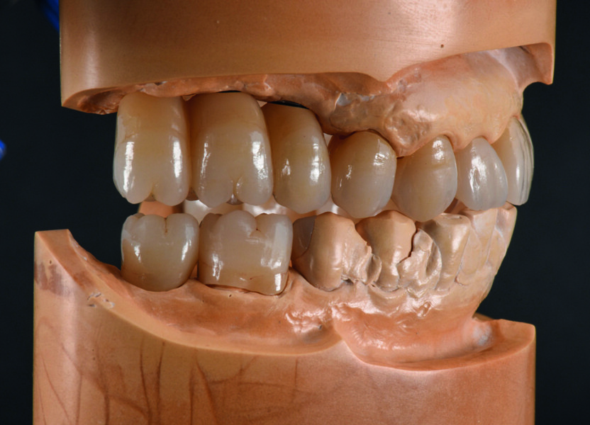 Fig. 9a : Surfaces occlusales et pente canine parfaites pendant le mouvement mandibulaire. 