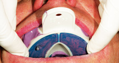 Advances in dental implant impressions
