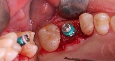 Małoinwazyjne podniesienie dna zatoki szczękowej z jednoczesną implantacją – opis przypadku