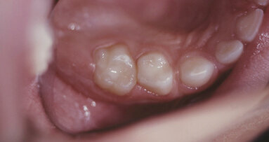 Irruvidire, pulire e preparare: le sabbiatrici nello studio dentistico sono una vera “bomba” per i pazienti