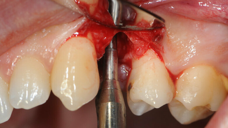 Immediate implants in the esthetic area: Our perspective and clinical guidelines