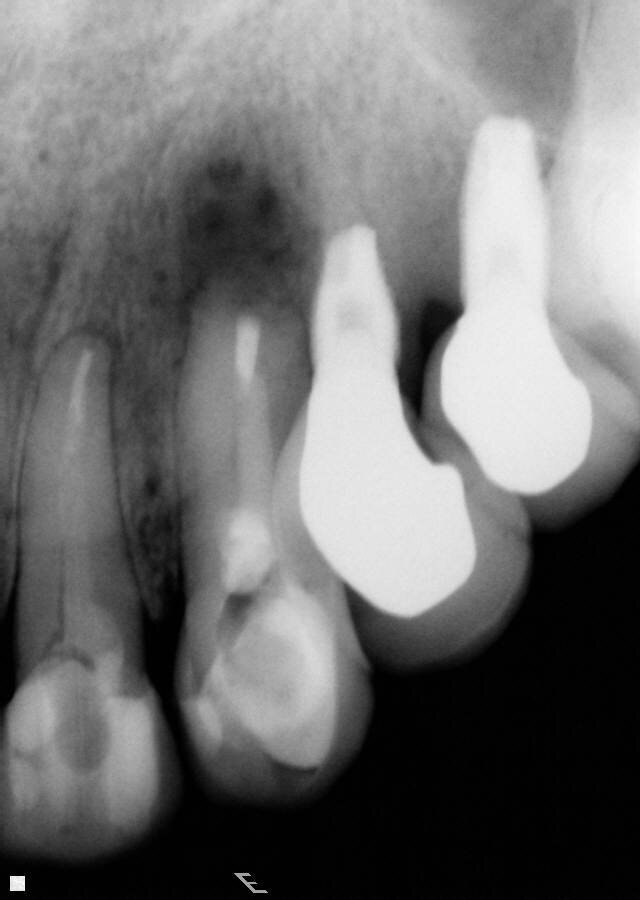 Fig. 5: Periapical radiographic follow-up after 30 and 90 days, showing a fast regression of the periapical lesion and a bone repair.