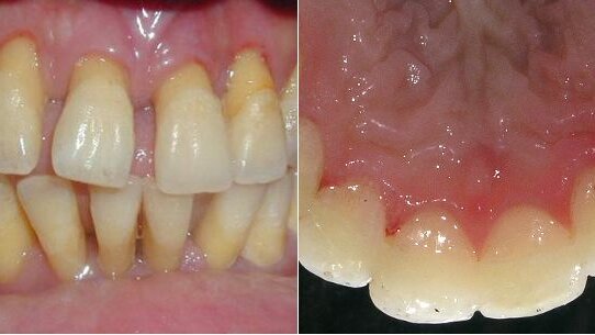 Maintenance of periodontally compromised teeth with direct splinting