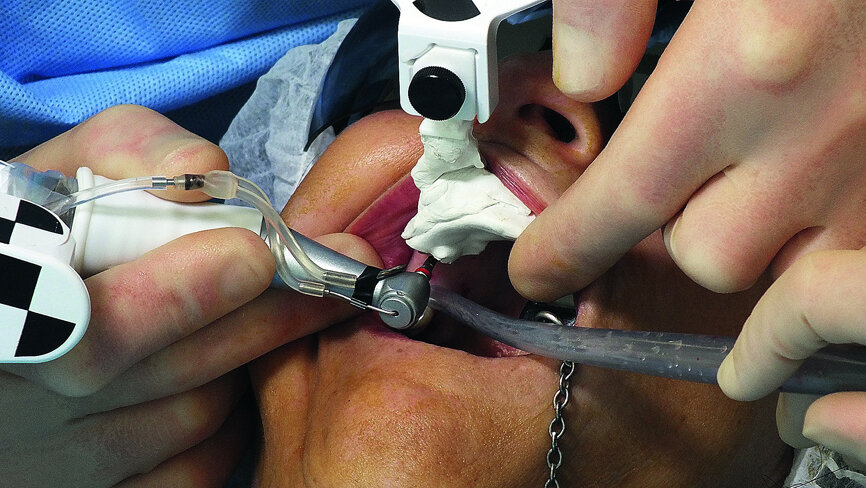 Fig. 10: Preparation of premolar site with 3.5 mm drill.