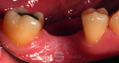 Implant restoration with CEREC