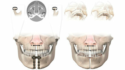 Kaakverbreding voorkomt extracties bij orthodontie