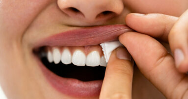 La Danish Dental Association è preoccupata per i danni irreversibili causati dall'uso di snus