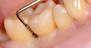 Case report: intervento di chirurgia ricostruttiva a seguito di terapia parodontale non chirurgica
